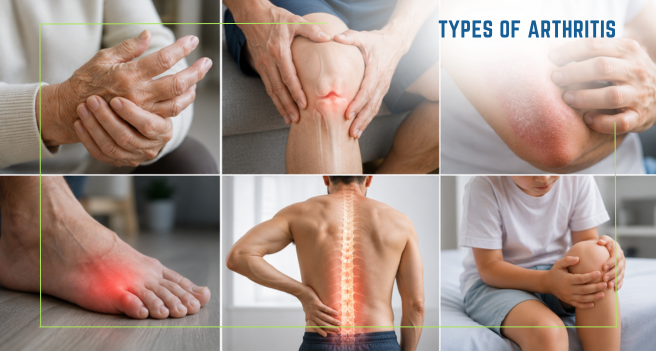 types of arthritis