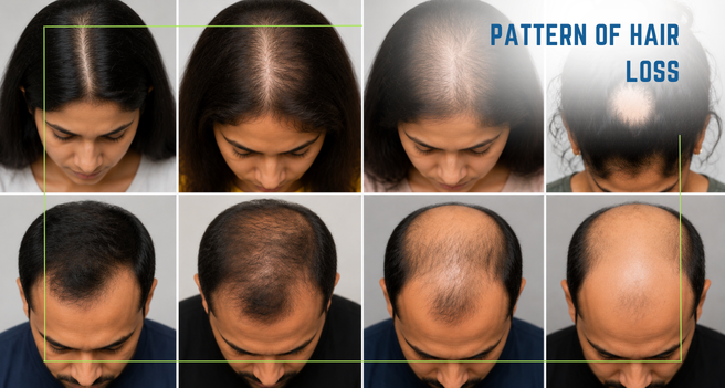 Pattern of Hair Loss
