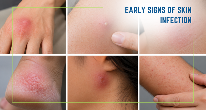 Early Signs of Skin Infection